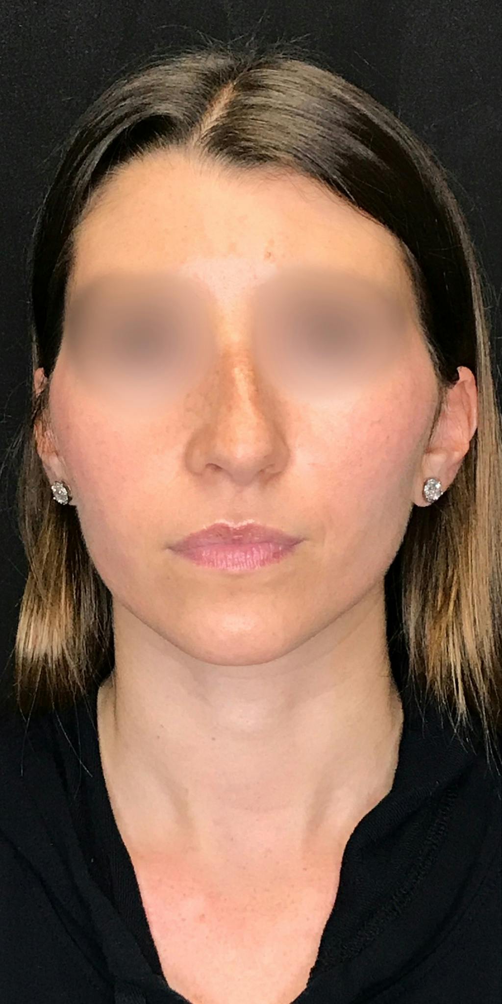 Rhinoplasty Before & After Gallery - Patient 151521037 - Image 5