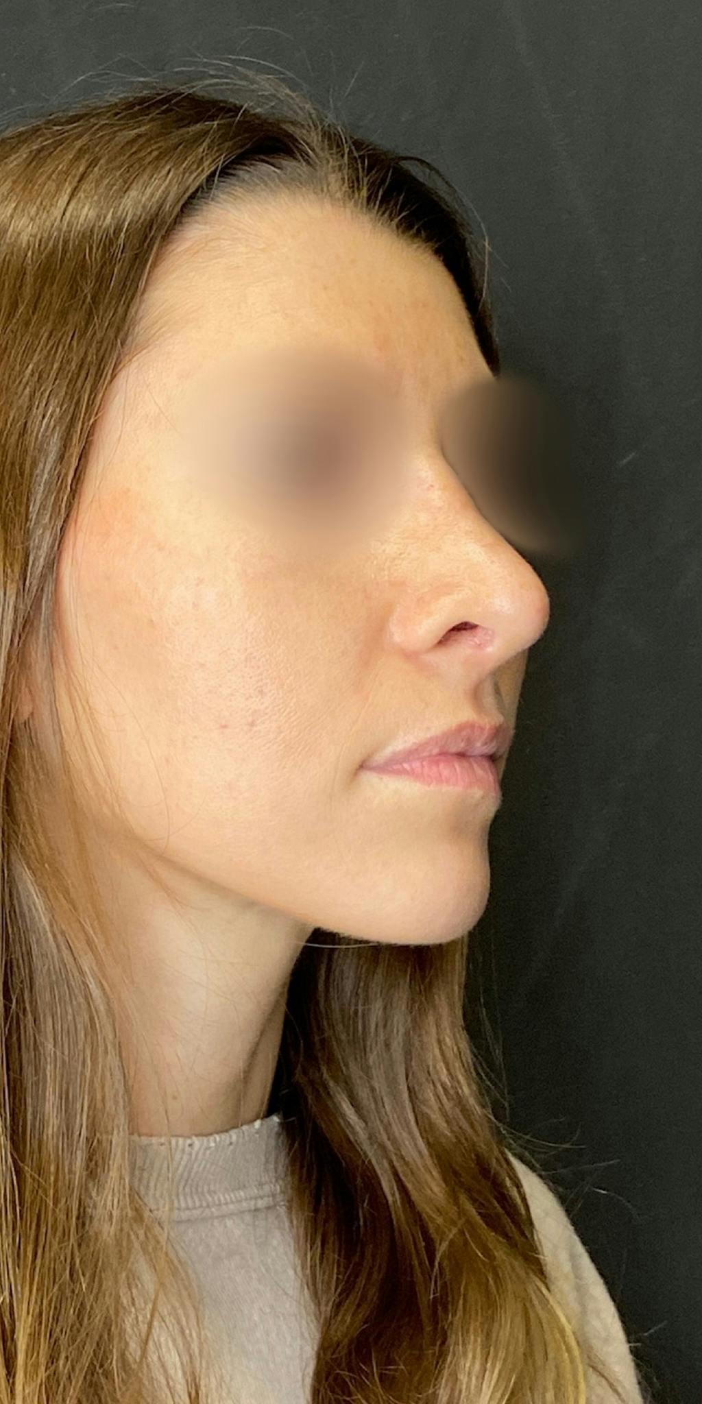 Rhinoplasty Before & After Gallery - Patient 151521037 - Image 3