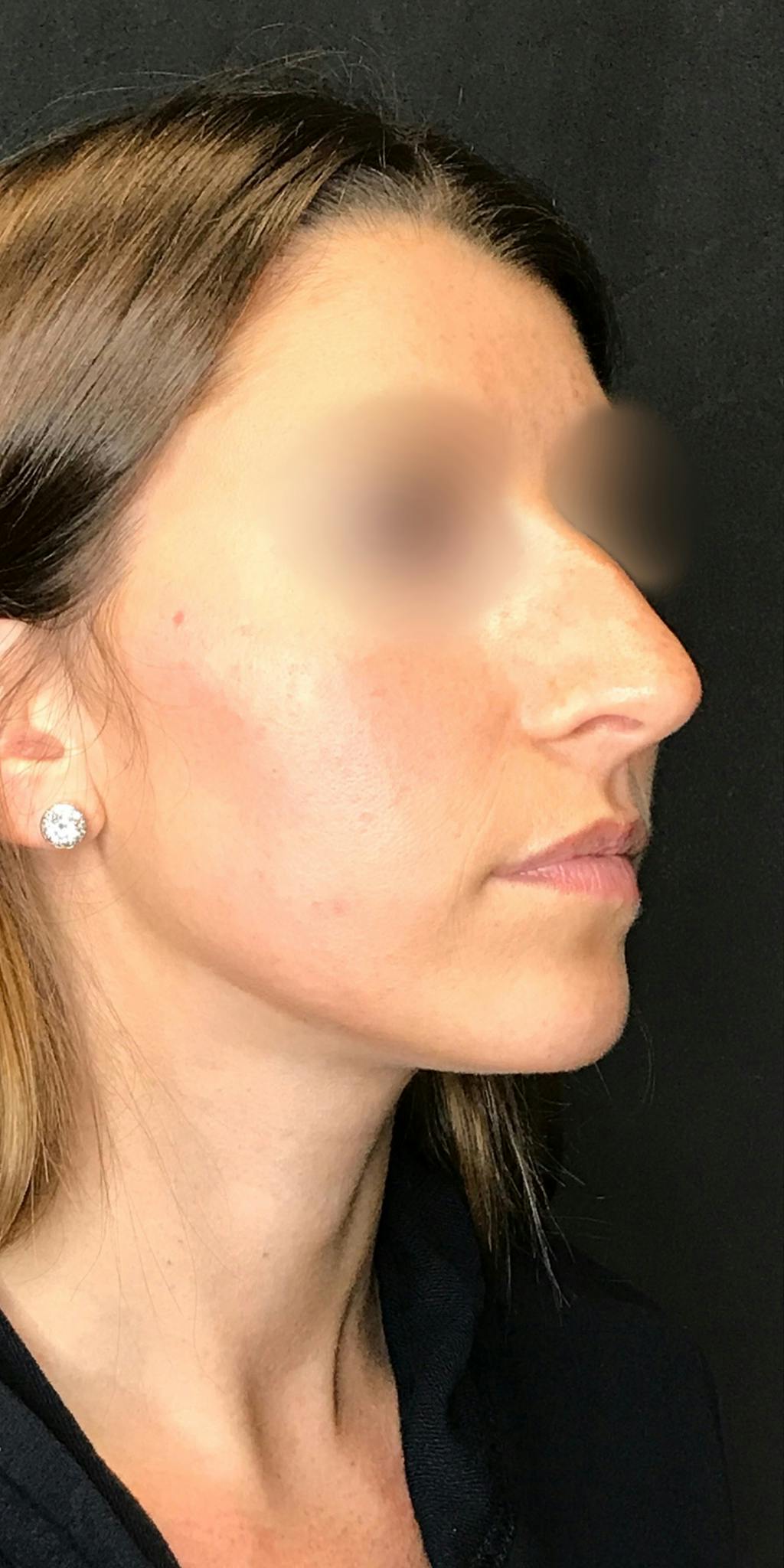 Rhinoplasty Before & After Gallery - Patient 151521037 - Image 4