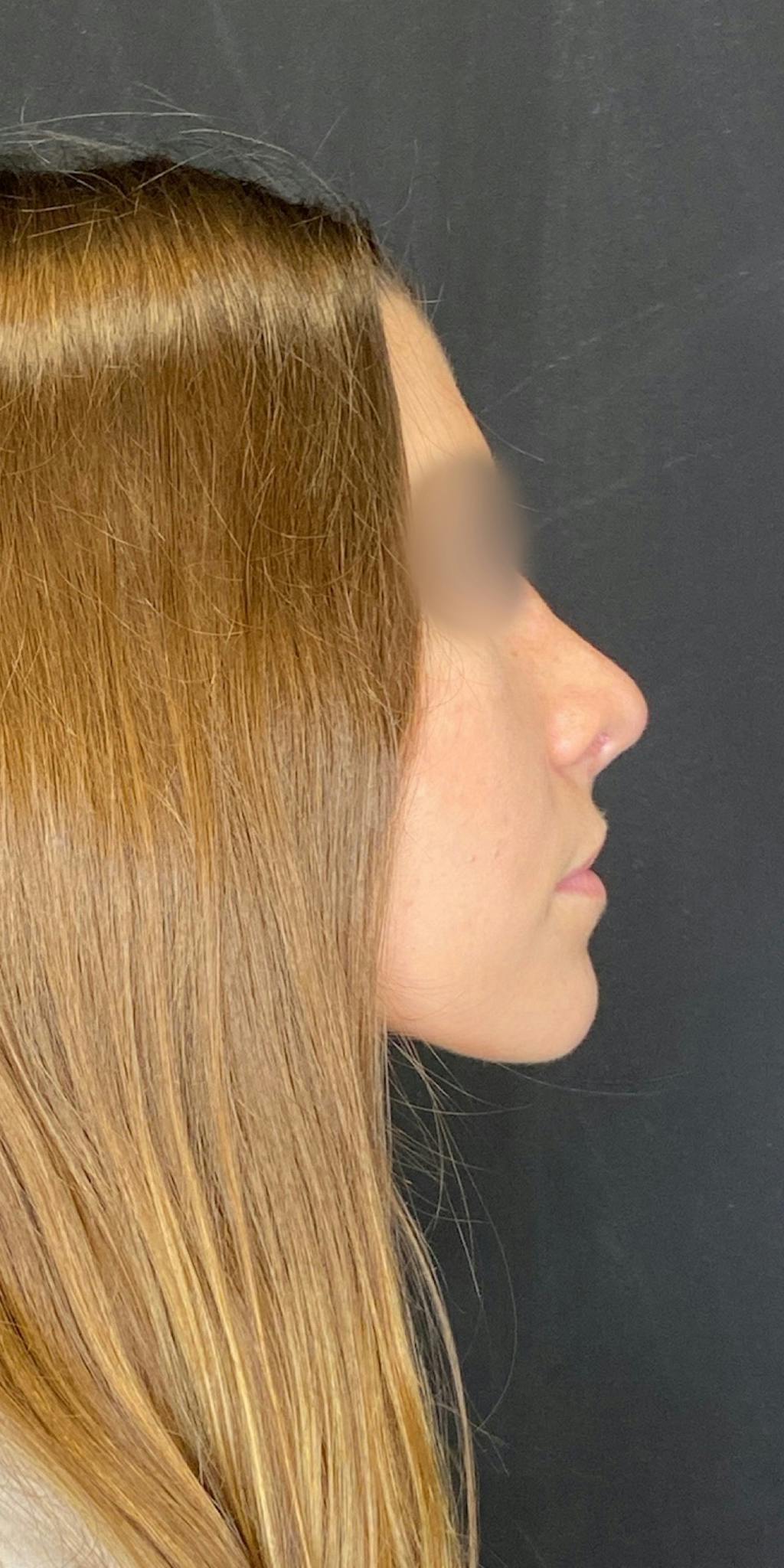 Rhinoplasty Before & After Gallery - Patient 151521037 - Image 2