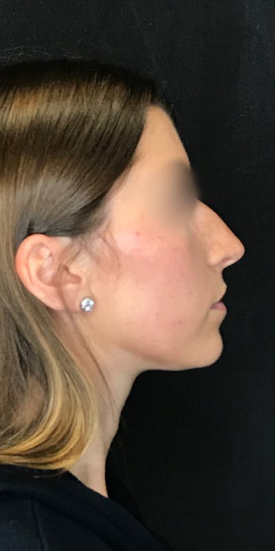 Rhinoplasty Before & After Gallery - Patient 151521037 - Image 1