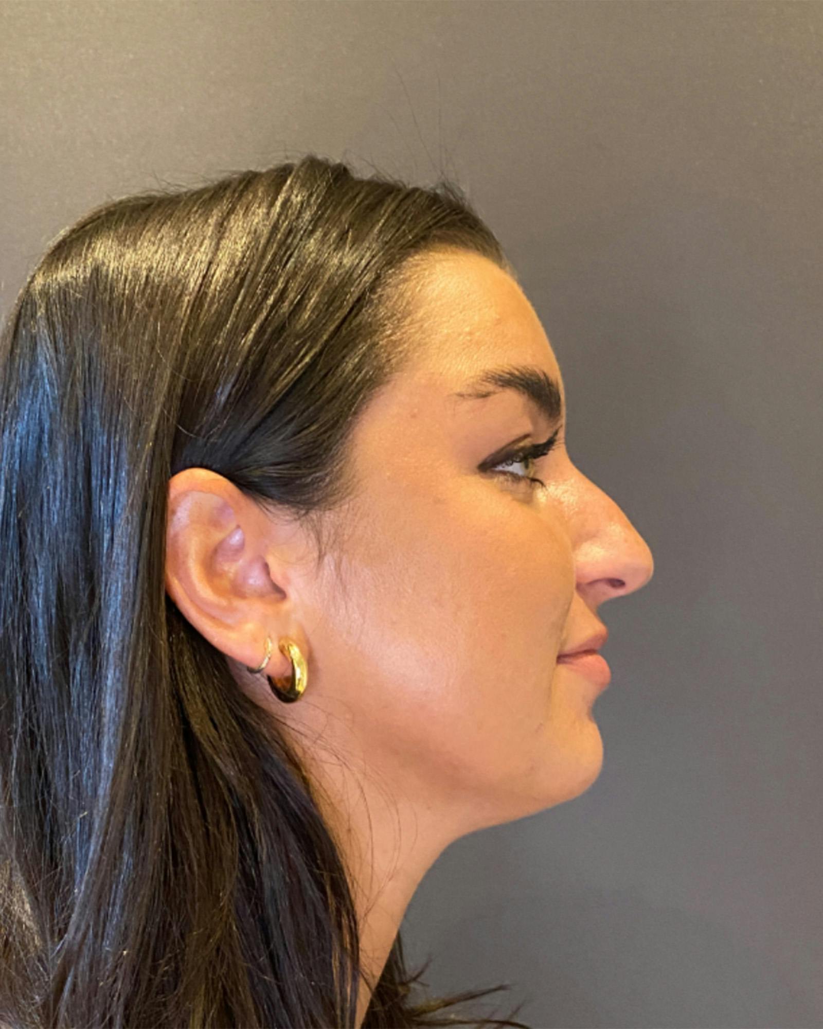 Rhinoplasty Before & After Gallery - Patient 151510778 - Image 1
