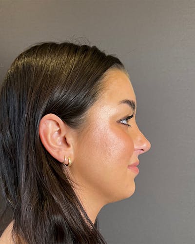 Rhinoplasty Before & After Gallery - Patient 151510778 - Image 2