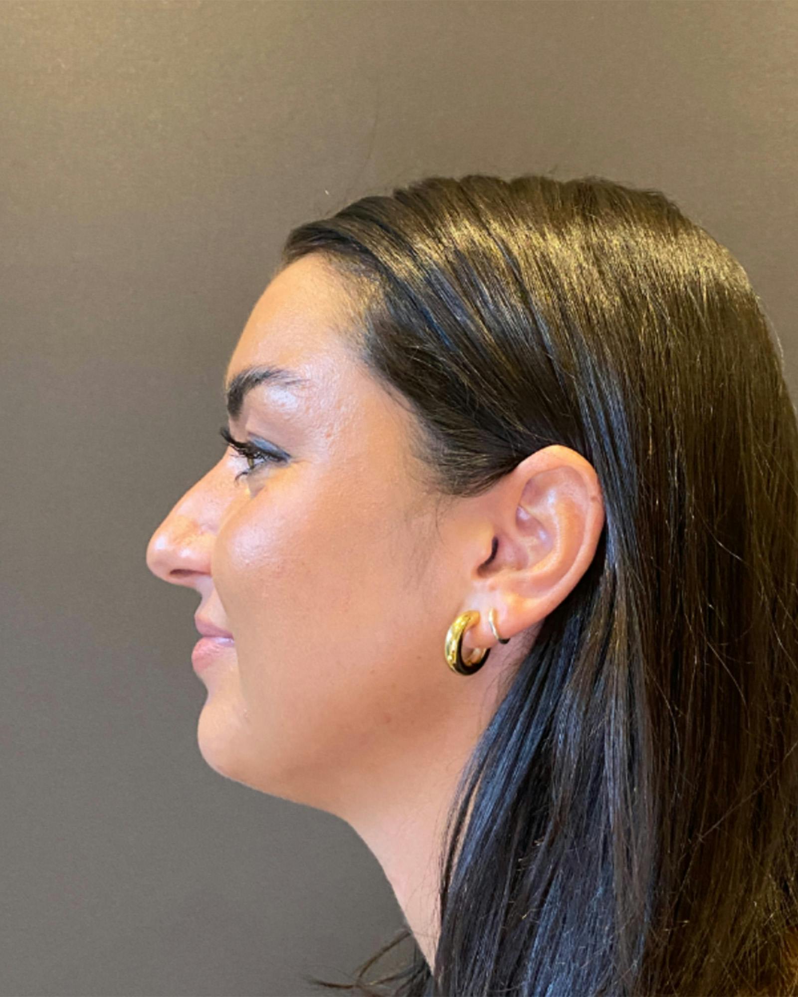 Rhinoplasty Before & After Gallery - Patient 151510778 - Image 7