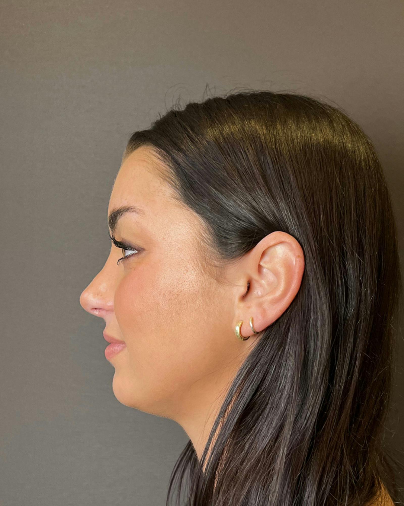 Rhinoplasty Before & After Gallery - Patient 151510778 - Image 8