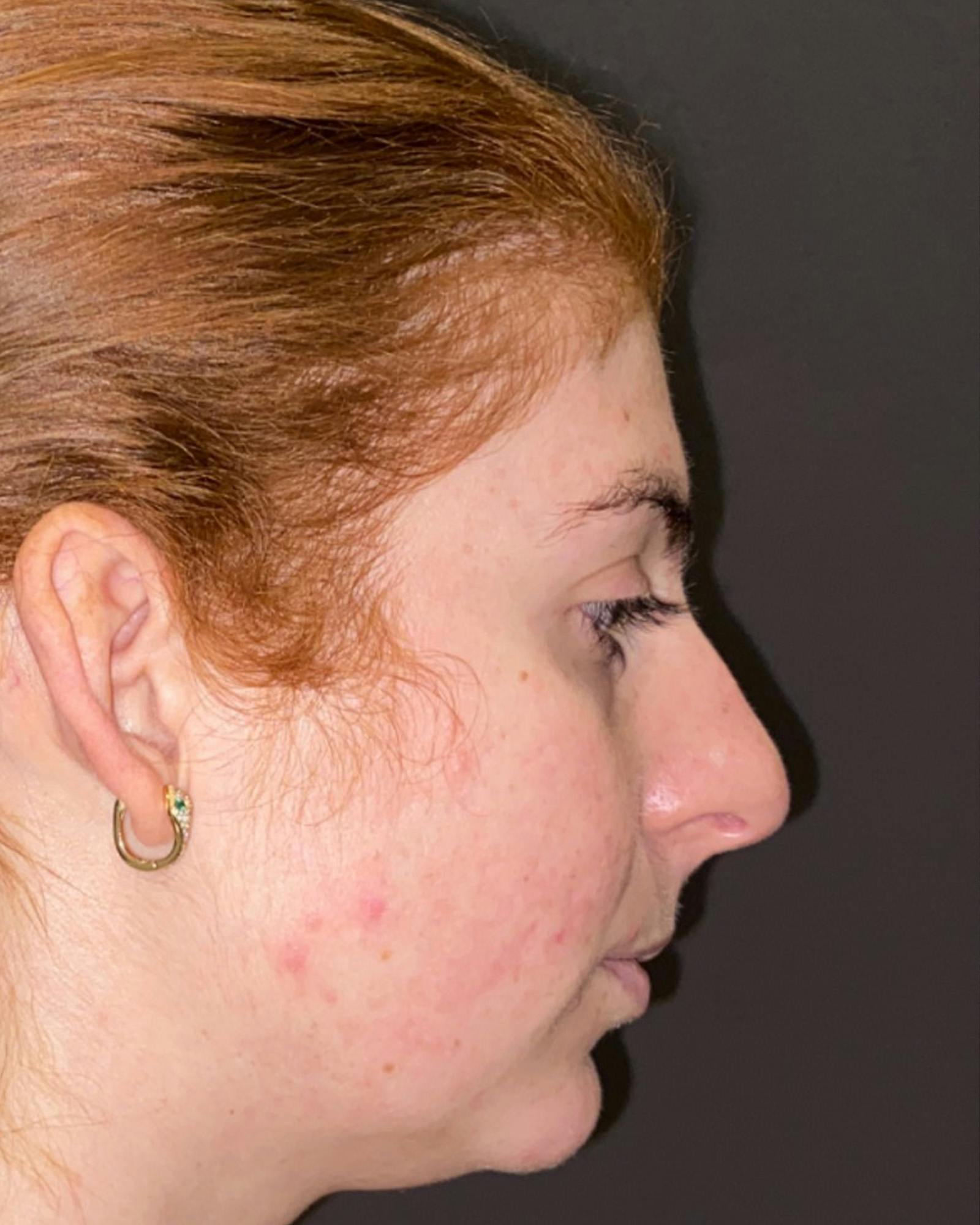 Rhinoplasty Before & After Gallery - Patient 151510780 - Image 1