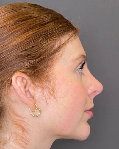 Rhinoplasty Before & After Gallery - Patient 151510780 - Image 2