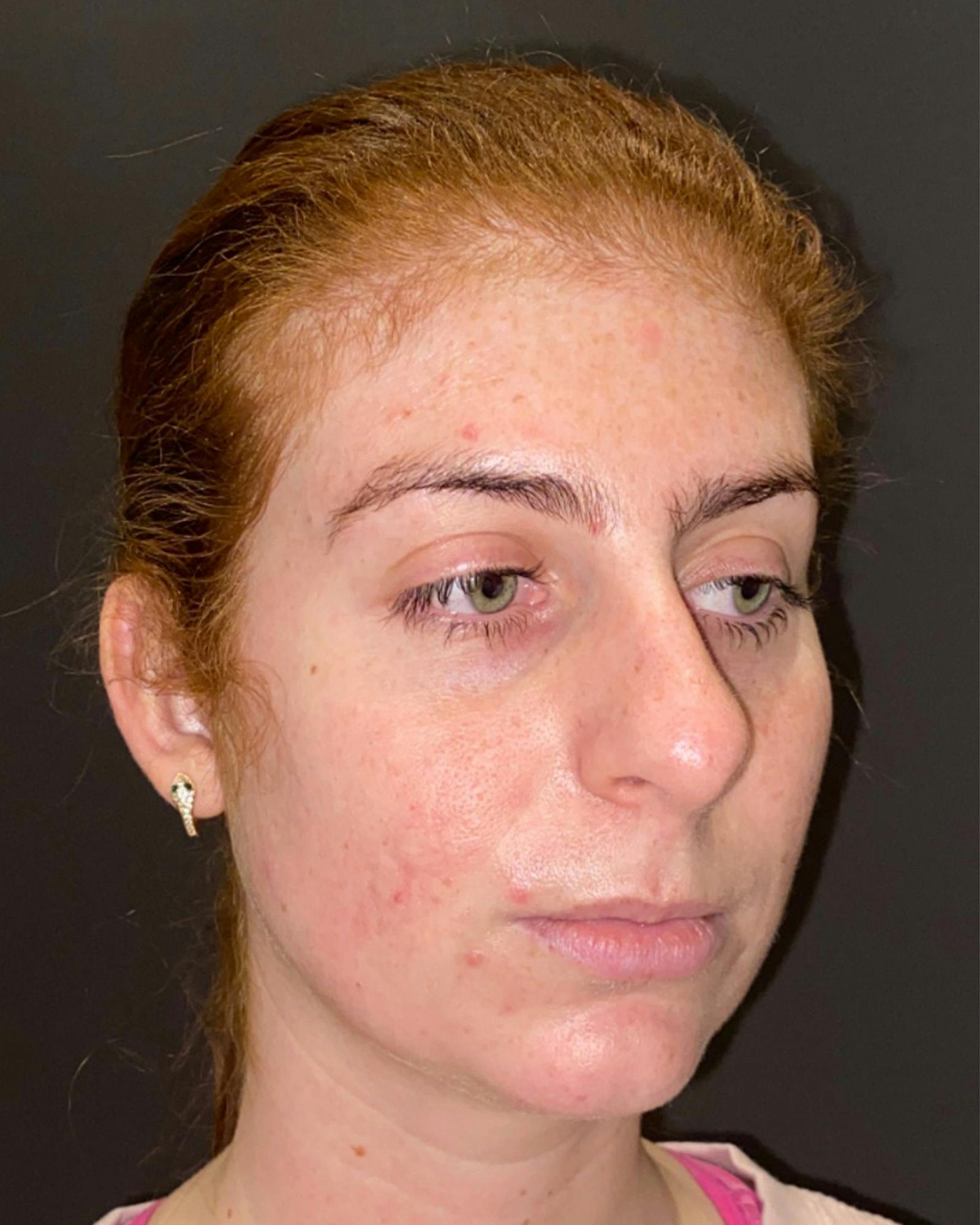 Rhinoplasty Before & After Gallery - Patient 151510780 - Image 3