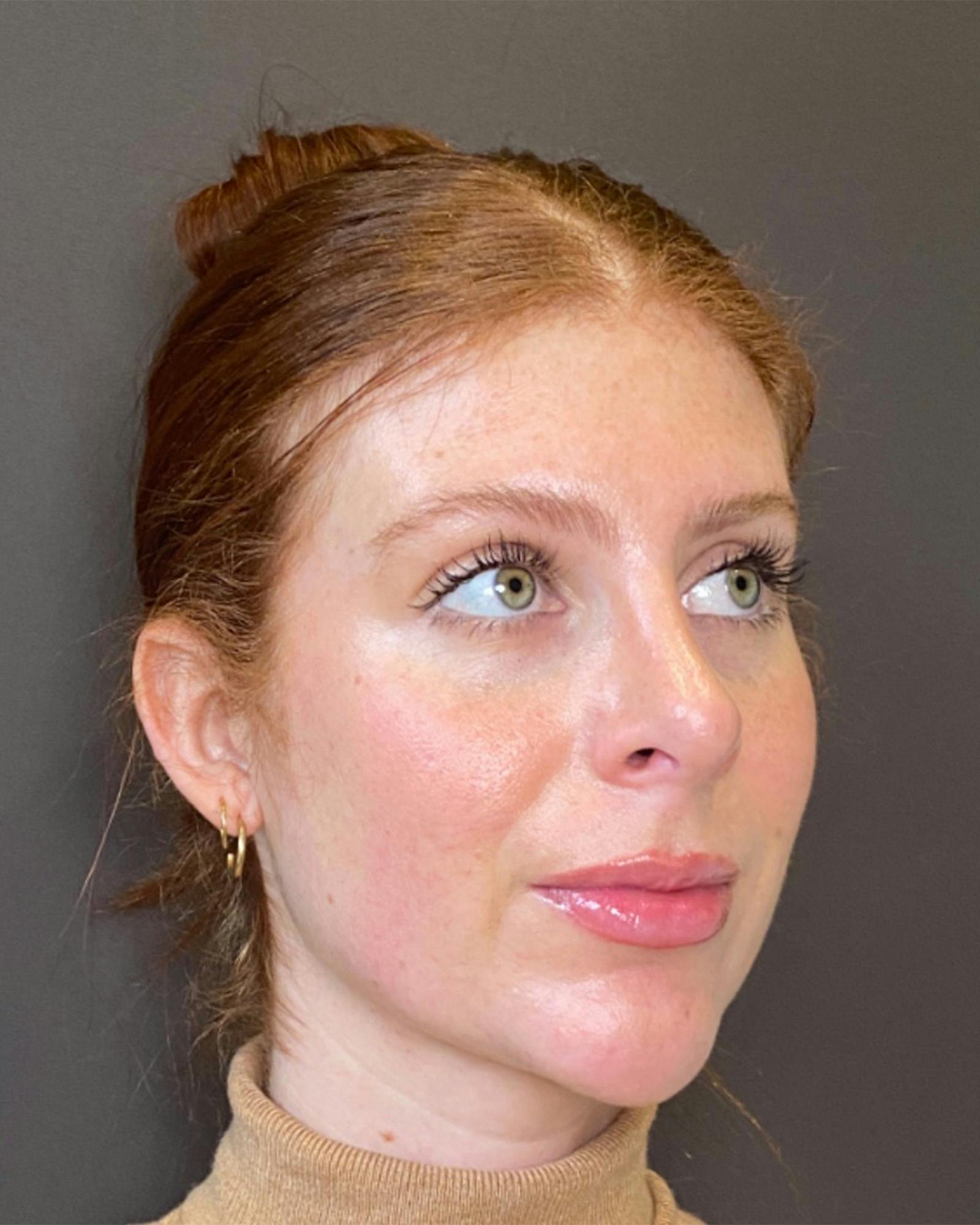 Rhinoplasty Before & After Gallery - Patient 151510780 - Image 4