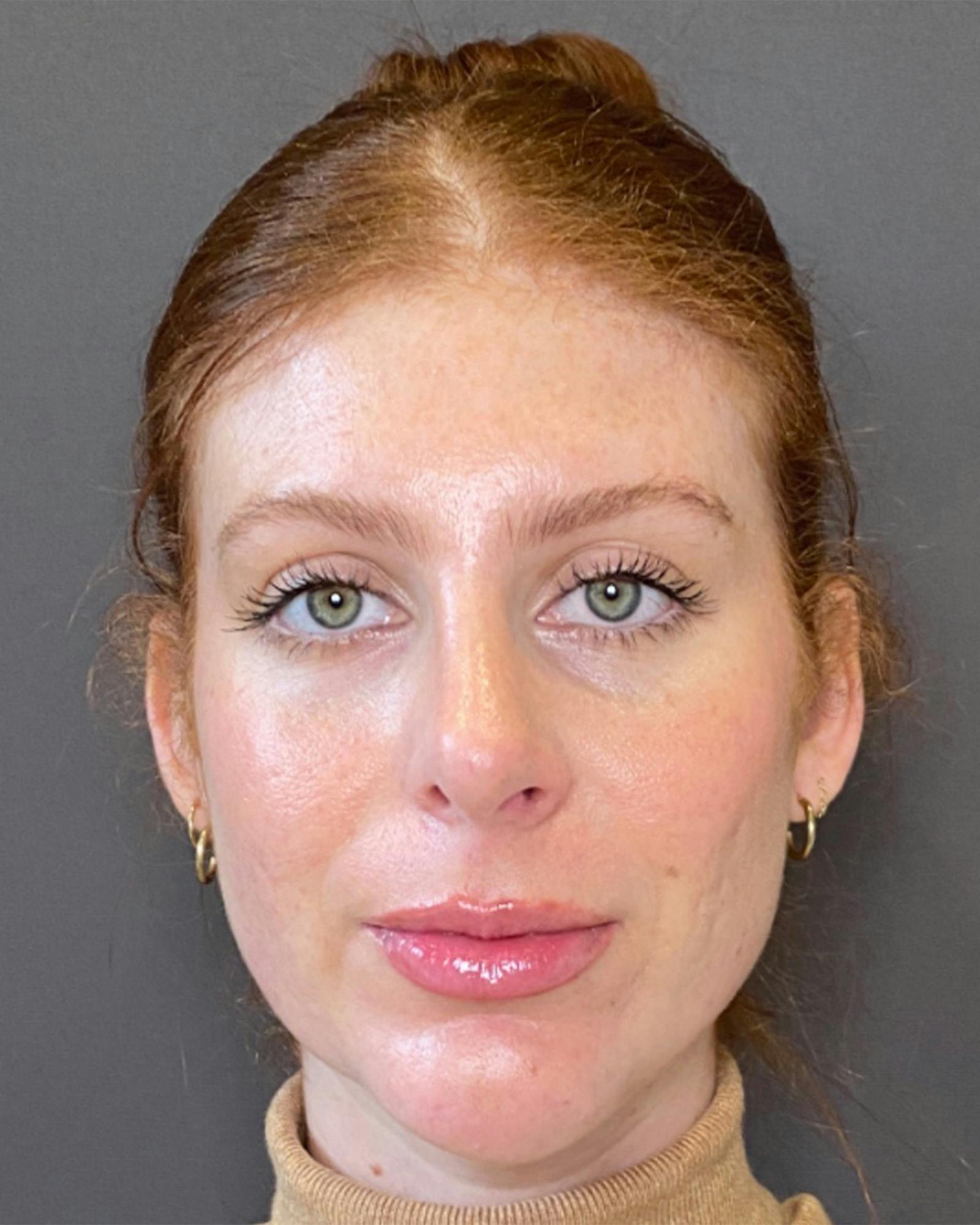 Rhinoplasty Before & After Gallery - Patient 151510780 - Image 6