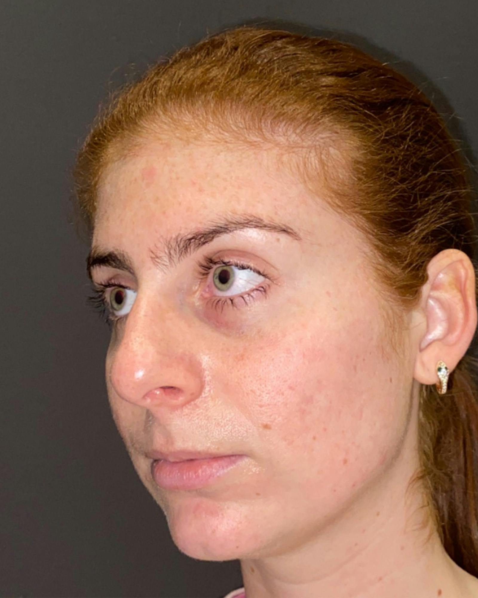 Rhinoplasty Before & After Gallery - Patient 151510780 - Image 7