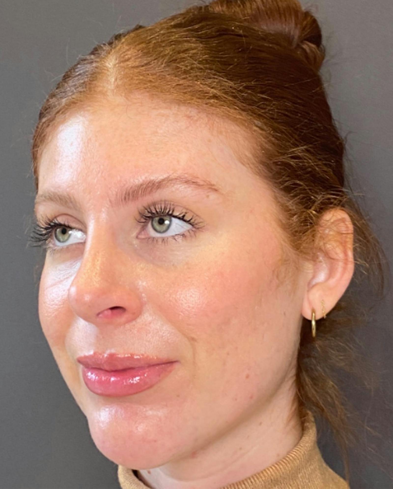 Rhinoplasty Before & After Gallery - Patient 151510780 - Image 8