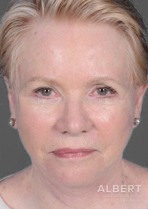 Facelifts / Necklift Before & After Gallery - Patient 151452105 - Image 6