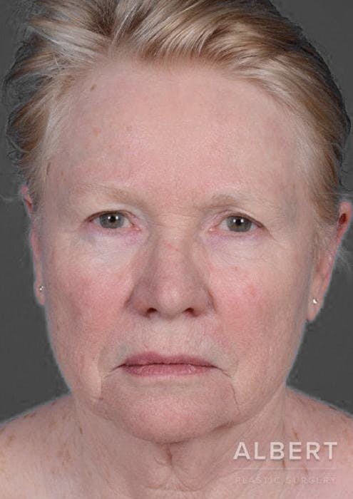 Facelifts / Necklift Before & After Gallery - Patient 151452105 - Image 5