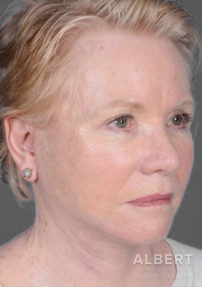 Facelifts / Necklift Before & After Gallery - Patient 151452105 - Image 2