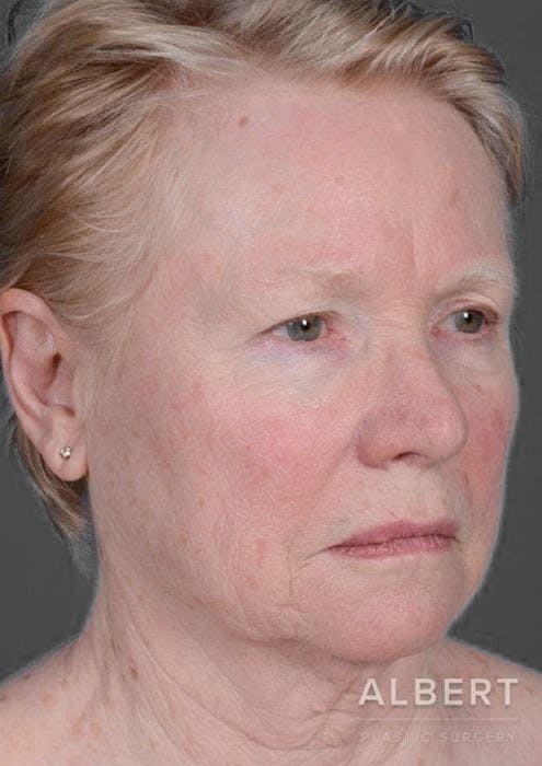 Facelifts / Necklift Before & After Gallery - Patient 151452105 - Image 3
