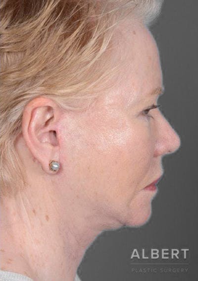 Facelifts / Necklift Before & After Gallery - Patient 151452105 - Image 2