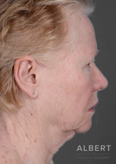 Facelifts / Necklift Before & After Gallery - Patient 151452105 - Image 1