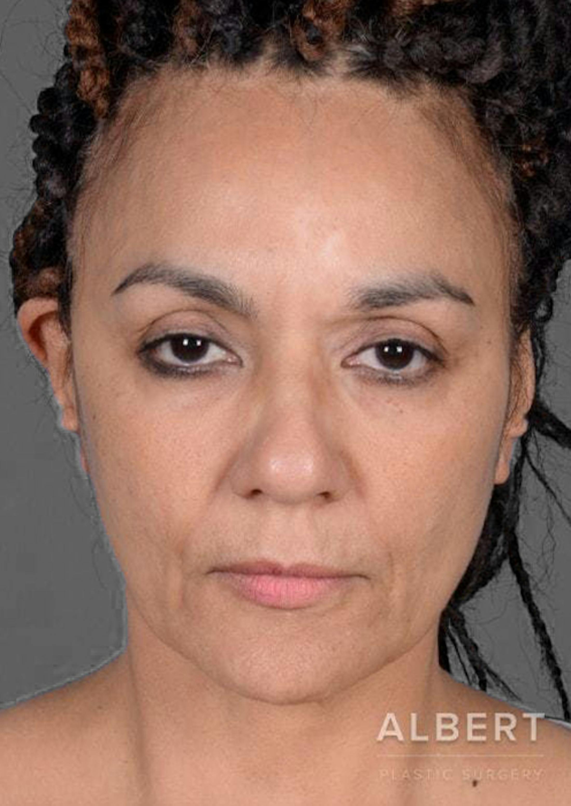 Mini Facelift in NYC Mini Facelift in New York