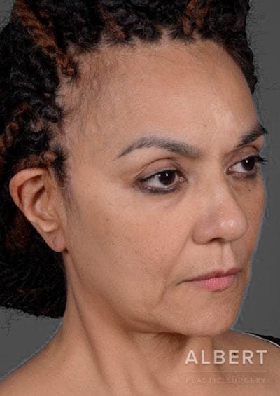 Before Mini Facelift Patient 151452106_Right Angle