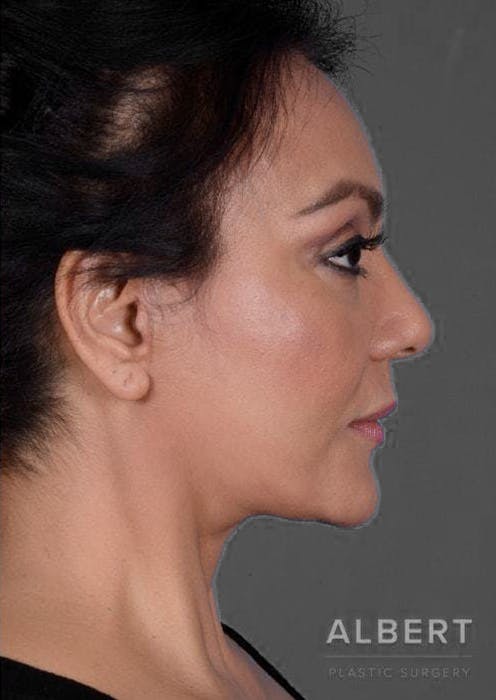 Facelift / Necklift Before & After Gallery - Patient 151452106 - Image 6
