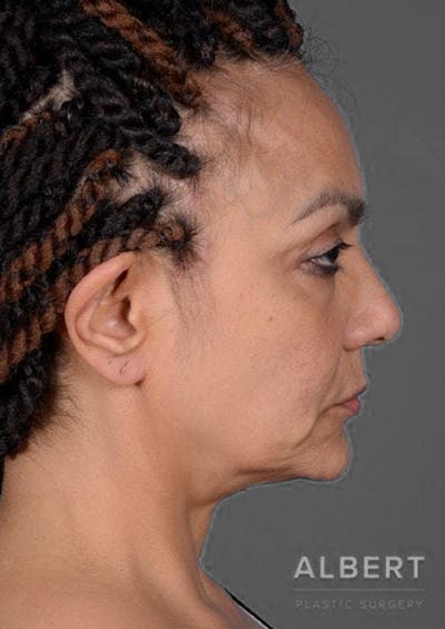 Before Mini Facelift Patient 151452106_Right Side
