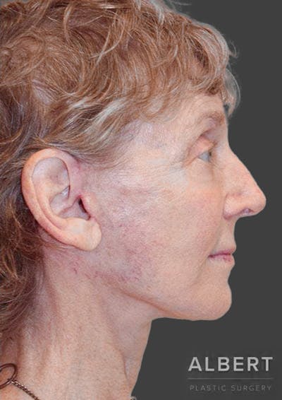Facelifts / Necklift Before & After Gallery - Patient 151452111 - Image 2