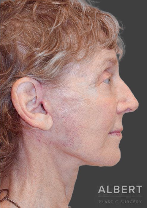Facelifts / Necklift Before & After Gallery - Patient 151452111 - Image 6