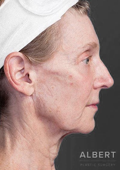 Facelifts / Necklift Before & After Gallery - Patient 151452111 - Image 1