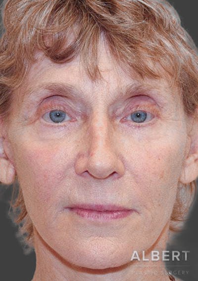 Facelift / Necklift Before & After Gallery - Patient 151452111 - Image 2
