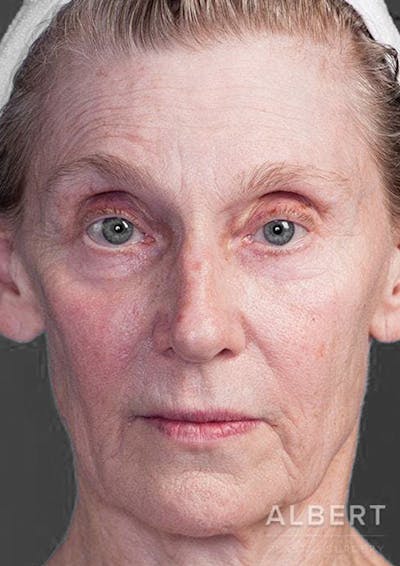 Facelift / Necklift Before & After Gallery - Patient 151452111 - Image 1