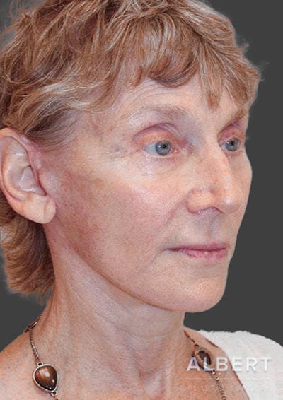 Facelifts / Necklift Before & After Gallery - Patient 151452111 - Image 2