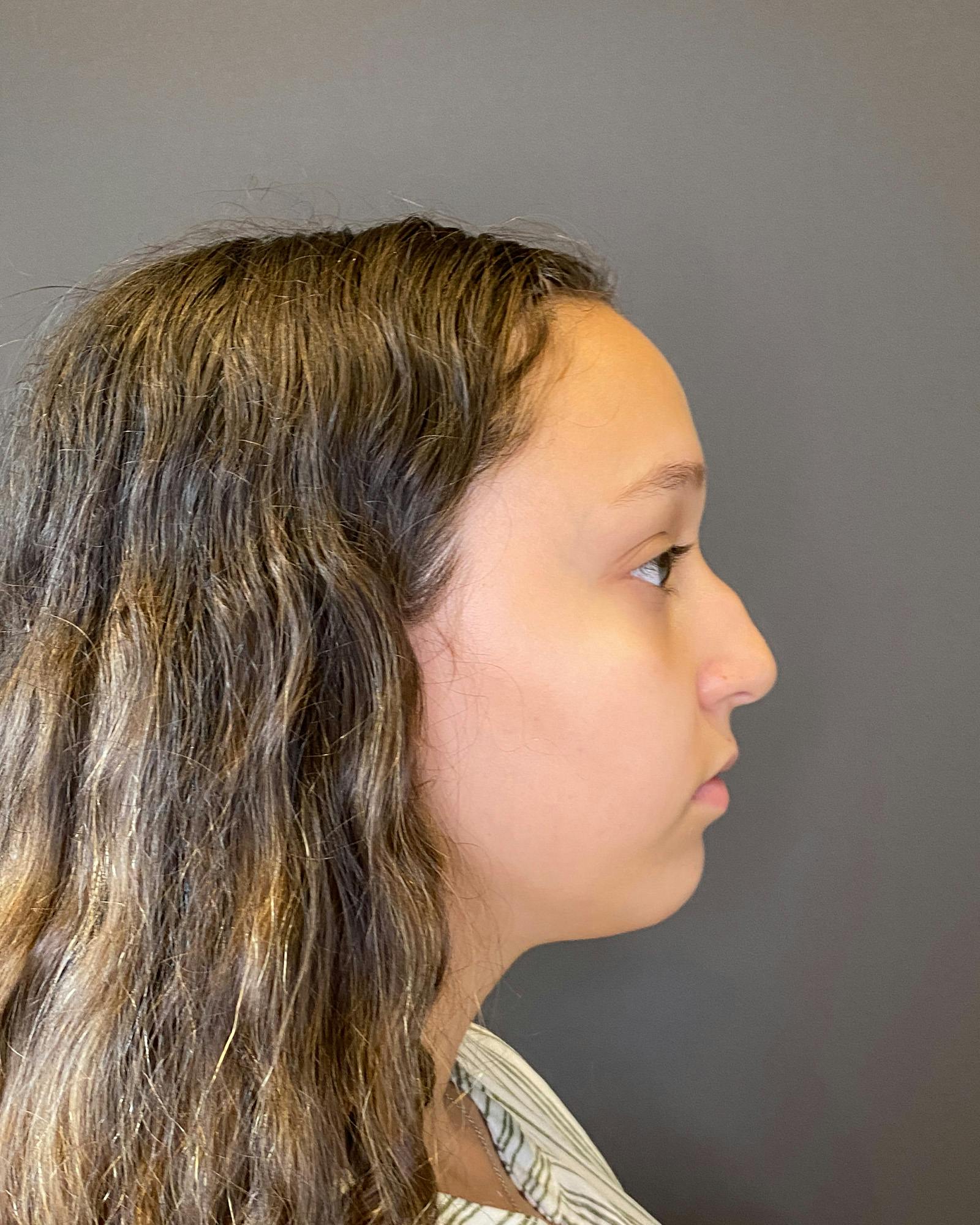 Rhinoplasty Before & After Gallery - Patient 151510781 - Image 1