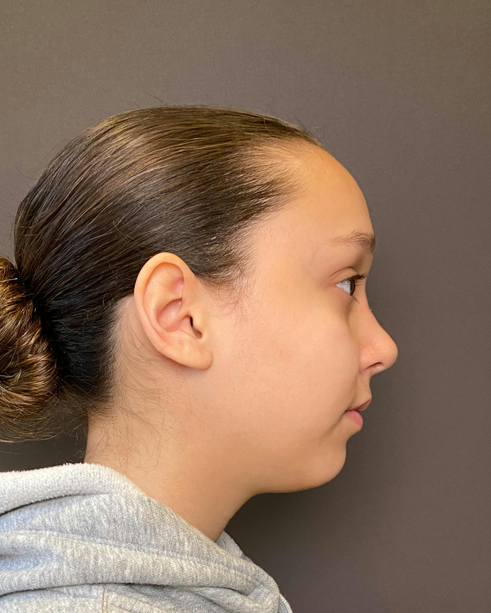Rhinoplasty Before & After Gallery - Patient 151510781 - Image 2