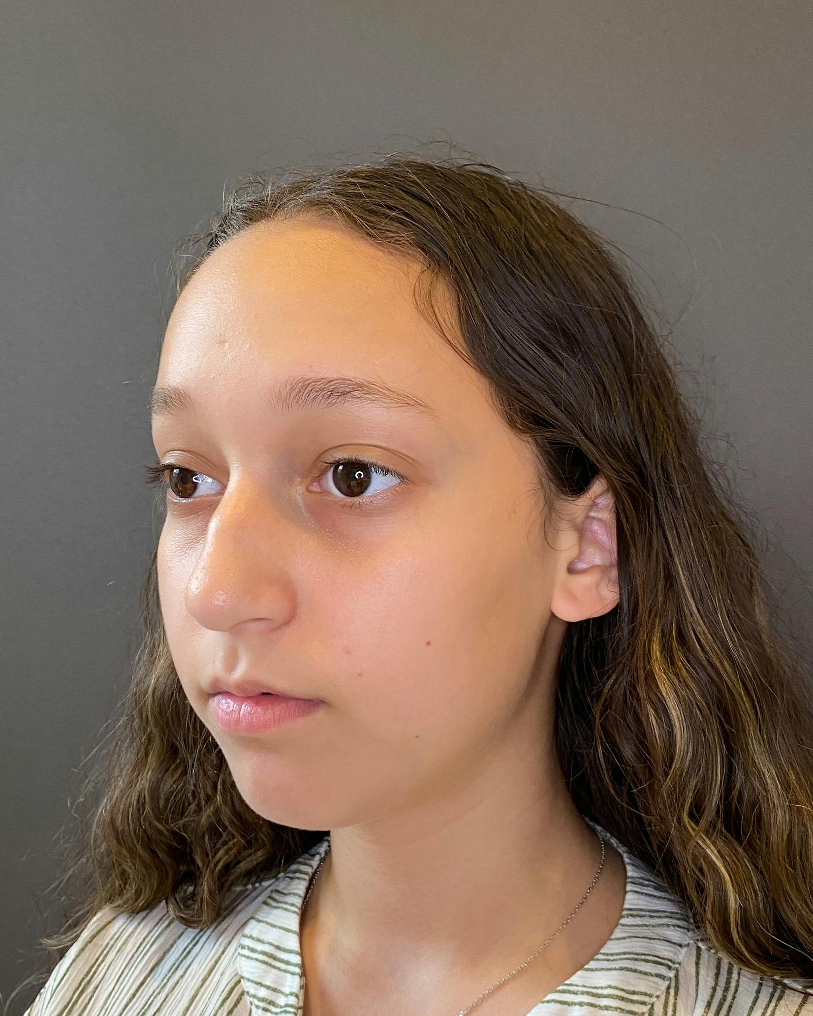 Rhinoplasty Before & After Gallery - Patient 151510781 - Image 7