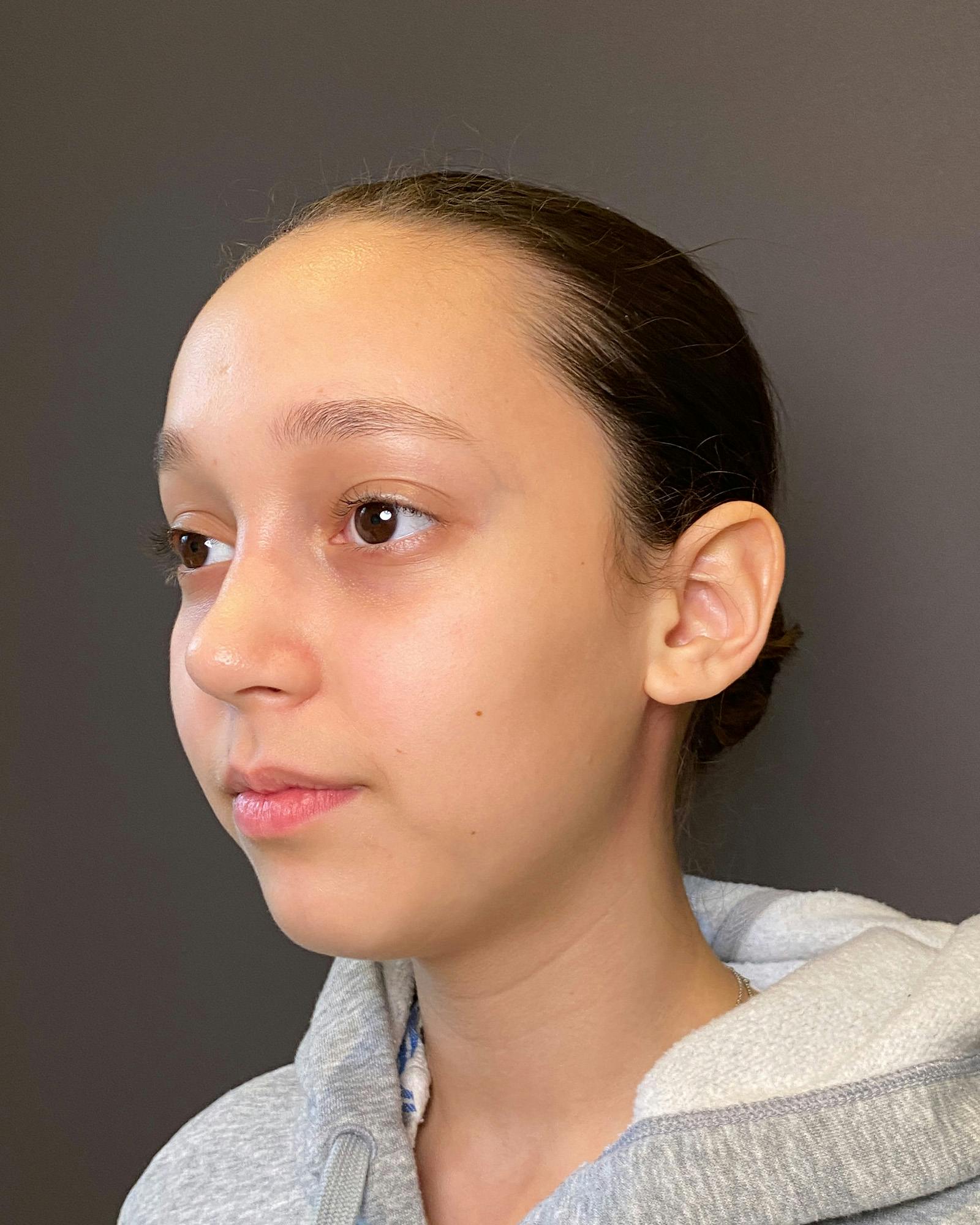 Rhinoplasty Before & After Gallery - Patient 151510781 - Image 8