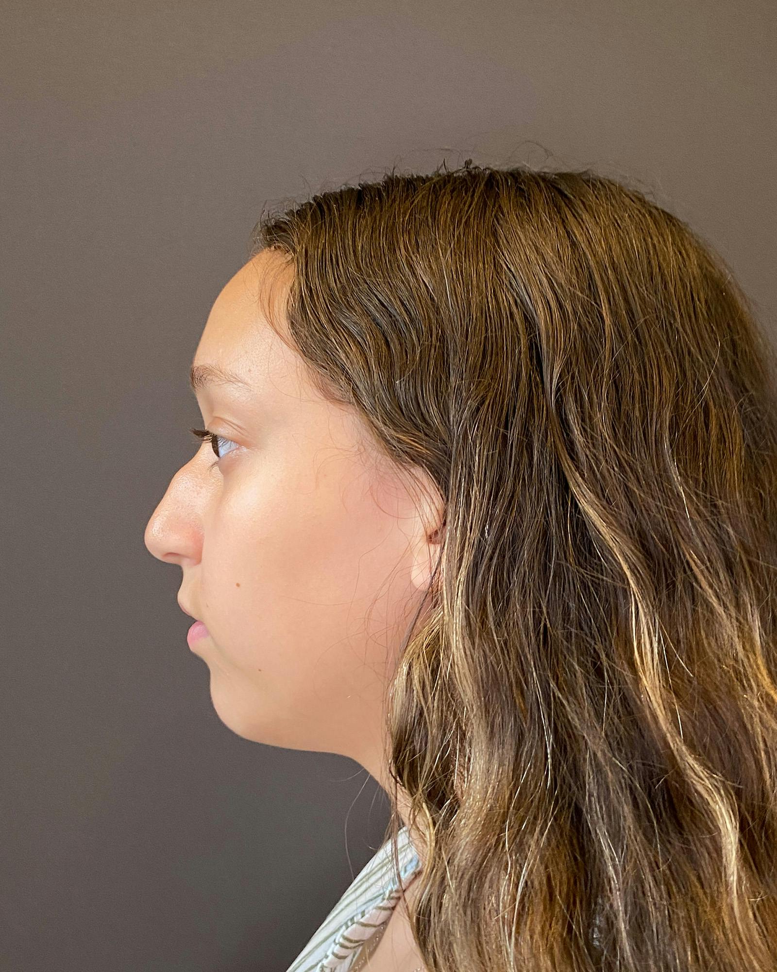 Rhinoplasty Before & After Gallery - Patient 151510781 - Image 9