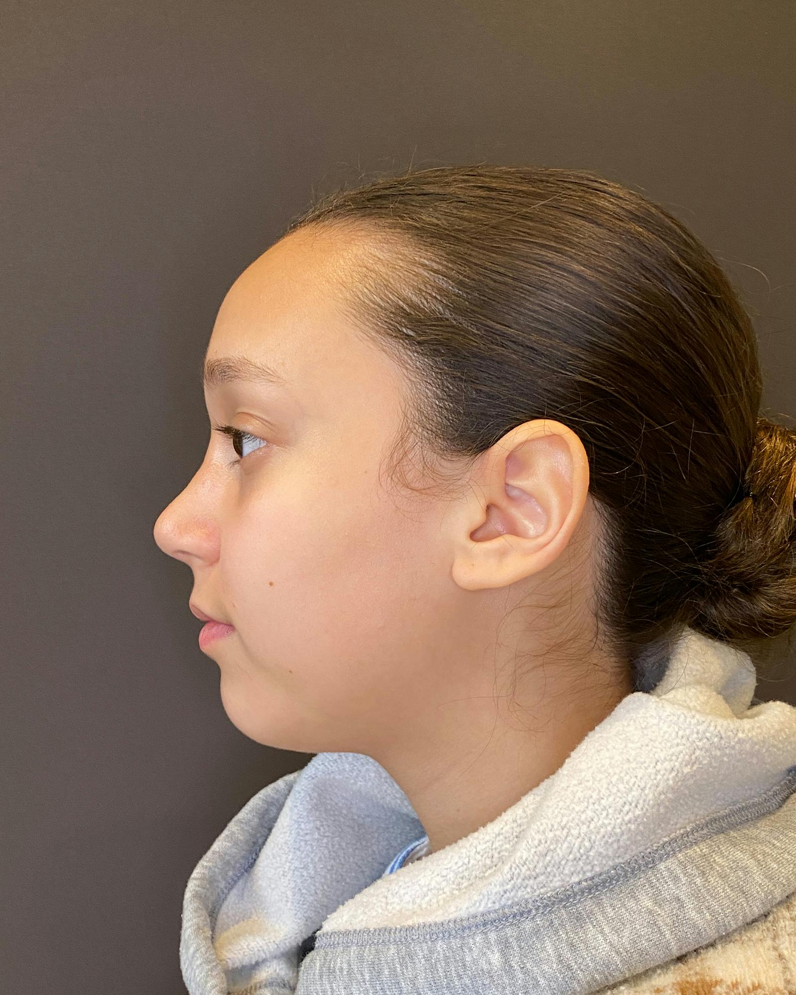 Rhinoplasty Before & After Gallery - Patient 151510781 - Image 10