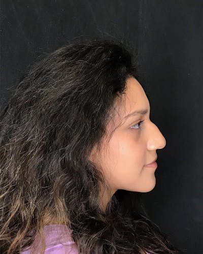 Rhinoplasty Before & After Gallery - Patient 151510789 - Image 1