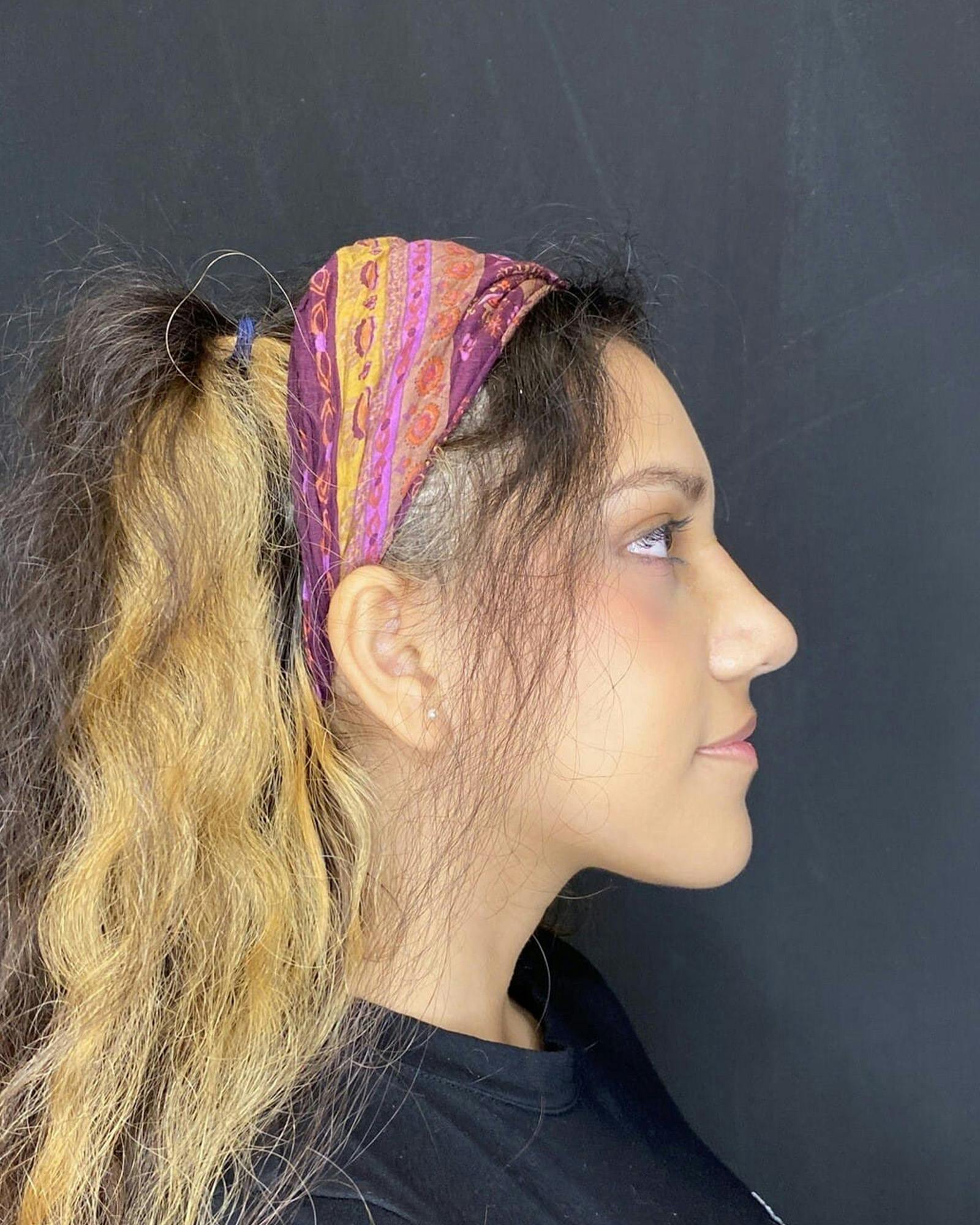 Rhinoplasty Before & After Gallery - Patient 151510789 - Image 2