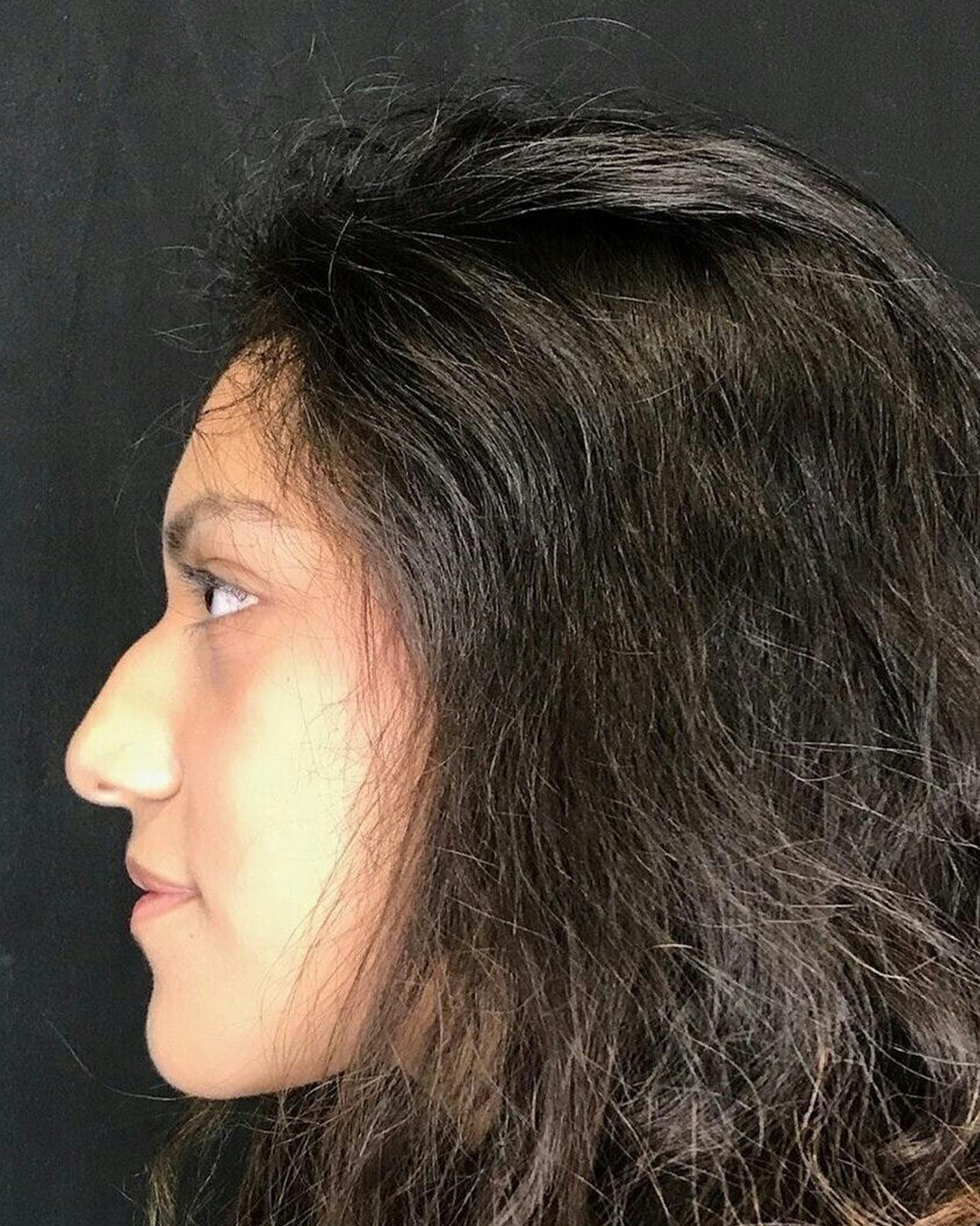 Rhinoplasty Before & After Gallery - Patient 151510789 - Image 5