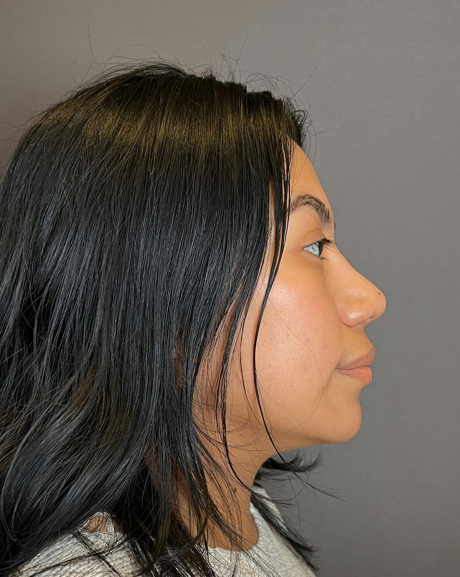Rhinoplasty Before & After Gallery - Patient 151521035 - Image 2