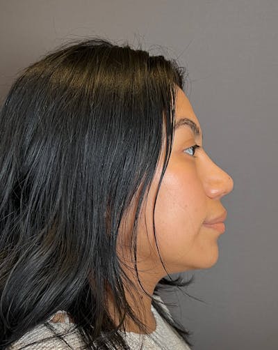 Rhinoplasty Before & After Gallery - Patient 151521035 - Image 2