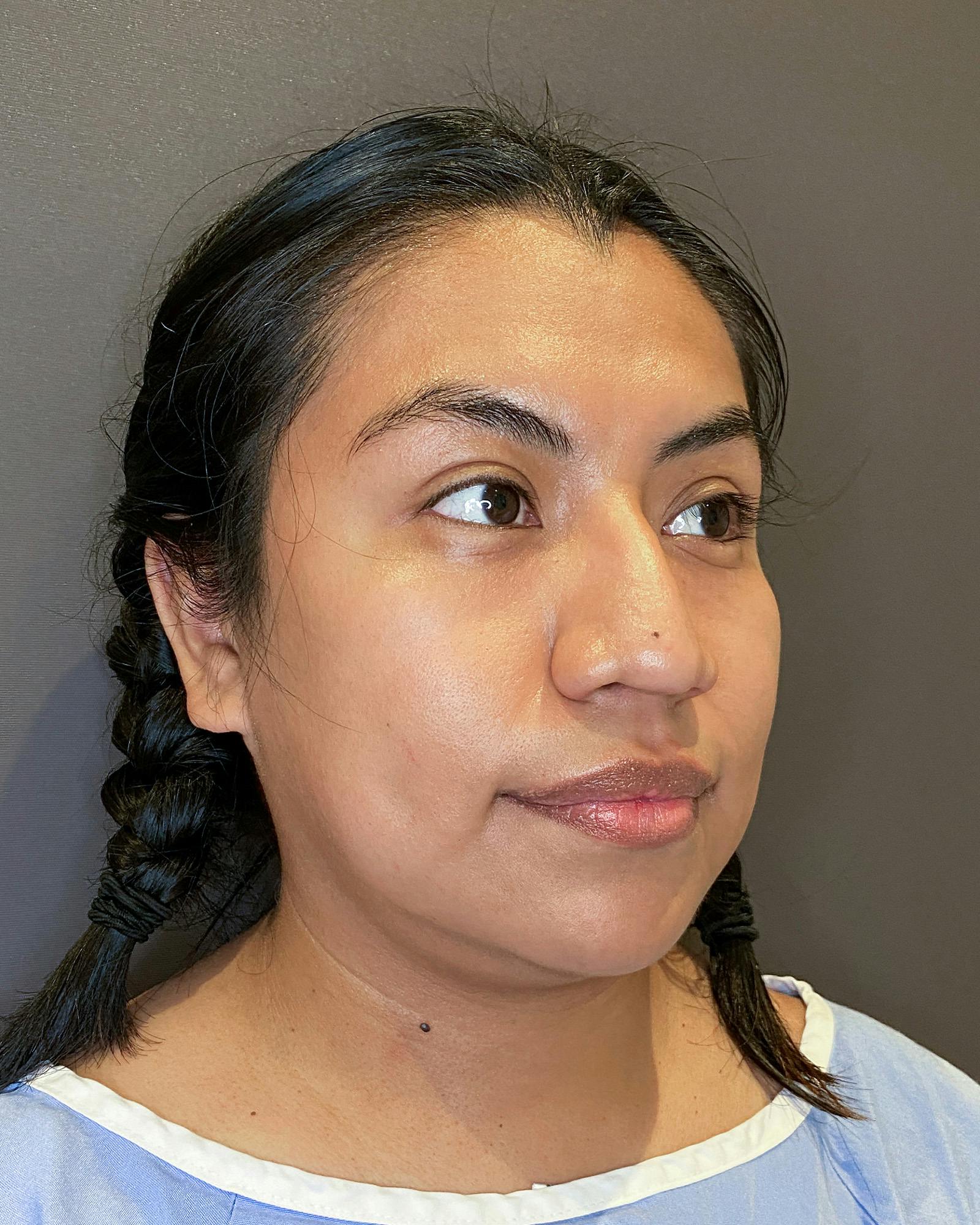 Rhinoplasty Before & After Gallery - Patient 151521035 - Image 3