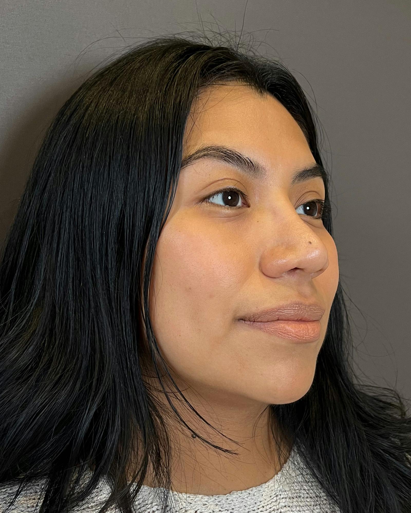 Rhinoplasty Before & After Gallery - Patient 151521035 - Image 4