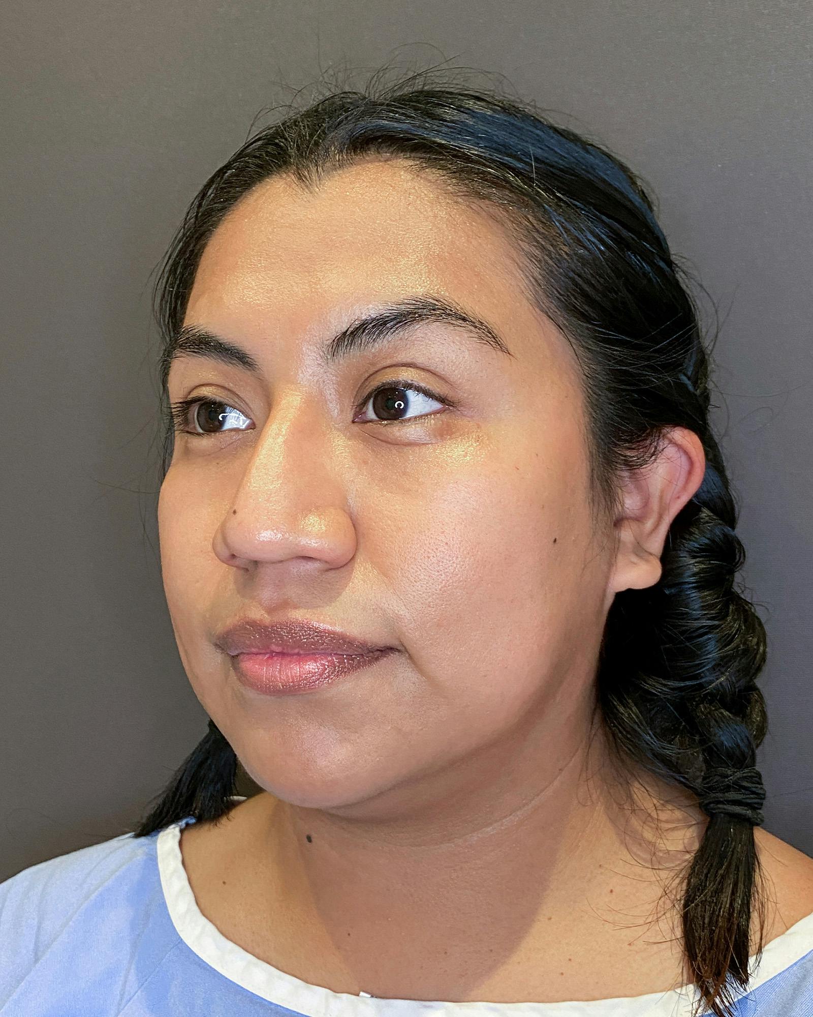 Rhinoplasty Before & After Gallery - Patient 151521035 - Image 7