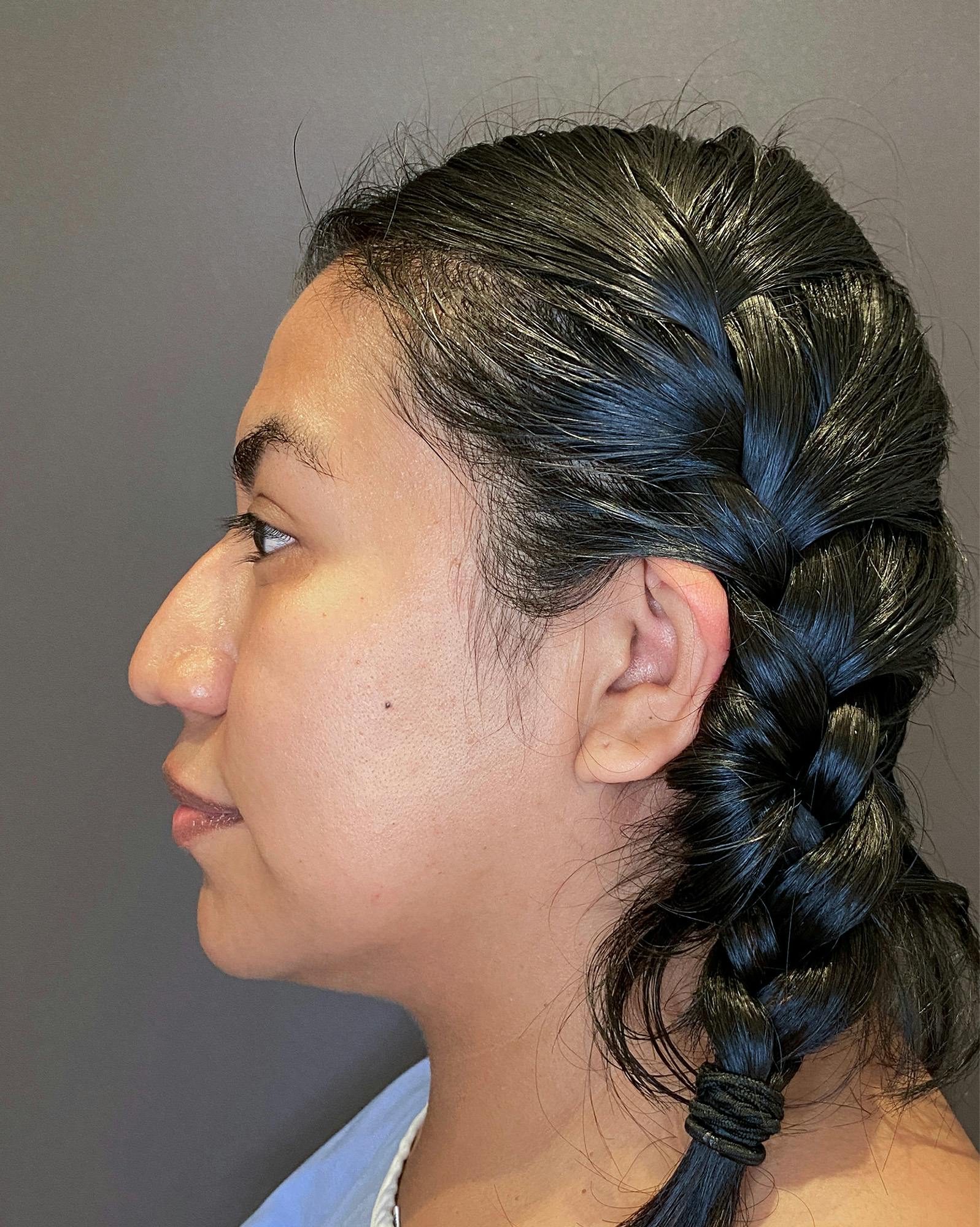 Rhinoplasty Before & After Gallery - Patient 151521035 - Image 9