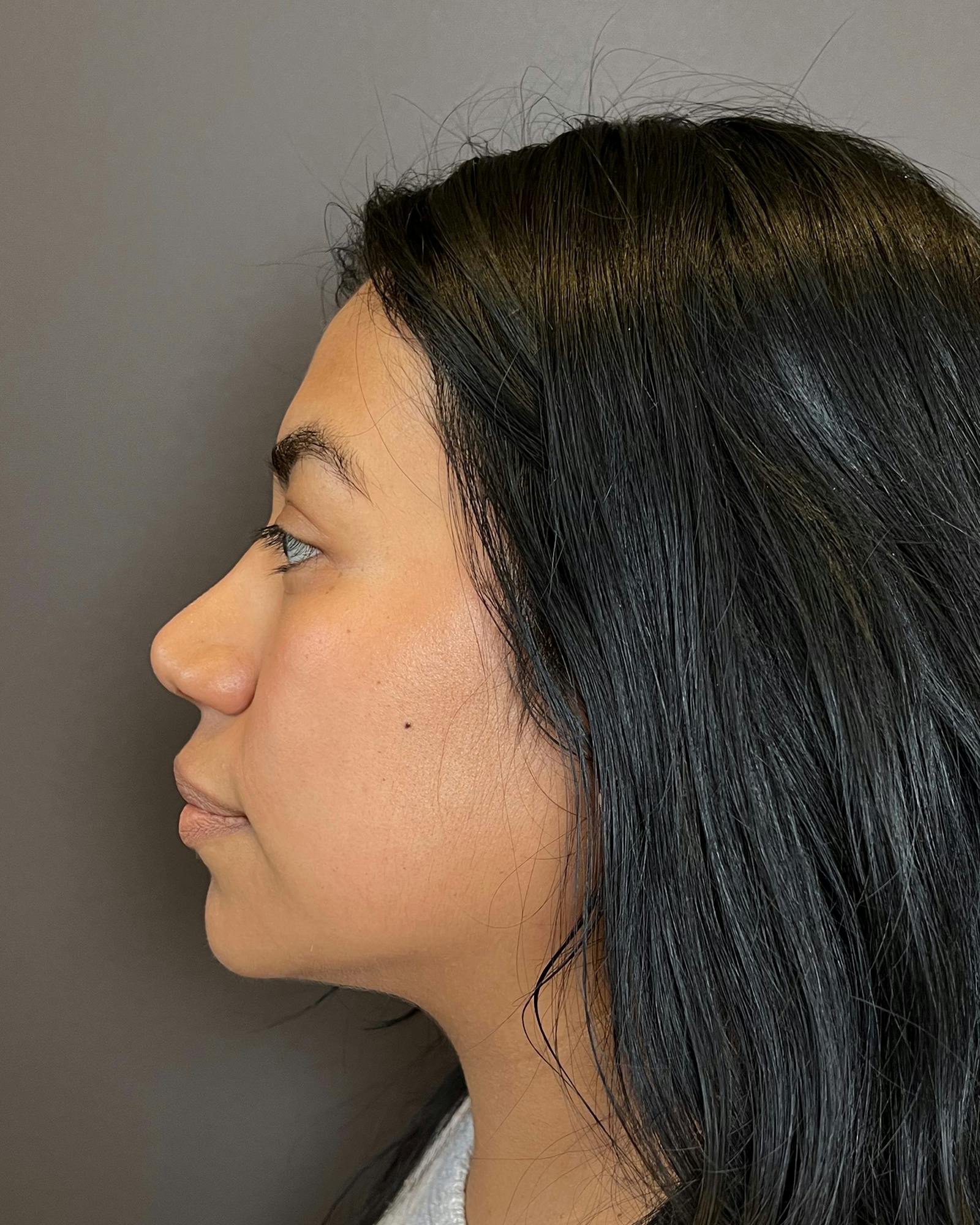 Rhinoplasty Before & After Gallery - Patient 151521035 - Image 10