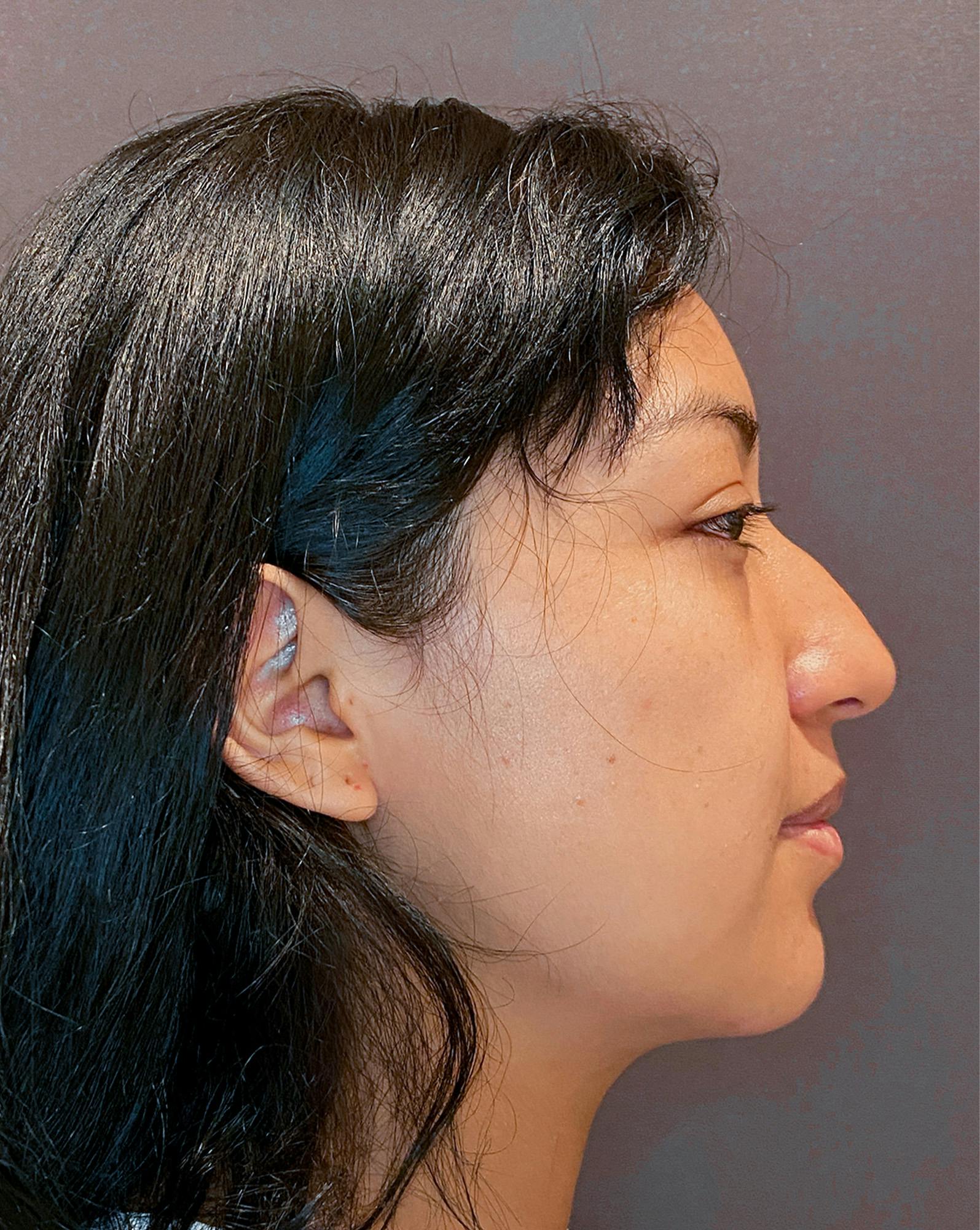 Rhinoplasty Before & After Gallery - Patient 151510782 - Image 1