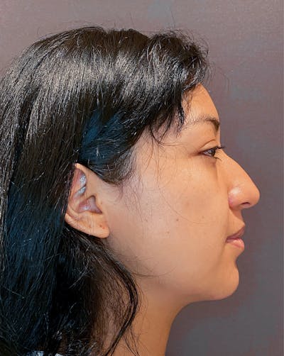 Rhinoplasty Before & After Gallery - Patient 151510782 - Image 1